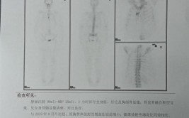 骨转移：造血功能终于恢复(乳腺癌生命人生造血晚期)