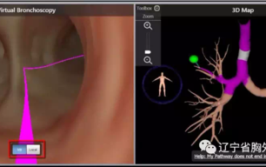 气管里的“导航系统“来了(结节病灶胸外科导航支气管镜)