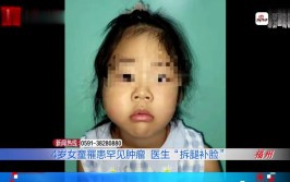 4岁女童右脸的骨头没了，医生“拆腿补脸”(肿瘤医生女童没了侵蚀)