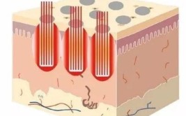 科普l为什么UP 雷射CO₂点阵激光可以称之为“痘坑神器”(点阵激光雷射神器科普)