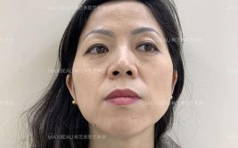 想要“减龄”和“饱满”现在却出现“凹坑”(女士医院硬结想要脸部)