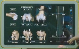 单县中心医院成功应用计算机导航系统实施人工全膝关节置换术(膝关节手术下肢患者置换)