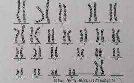 染色体平衡易位寿命短吗