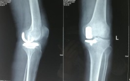 陕北首例 | Smith\u0026Nephew knee joint 手术计算机导航下全膝关节表面置换术在榆林二院完成(榆林膝关节手术骨科关节)