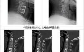 颈椎前路手术(颈椎前路手术椎体融合)