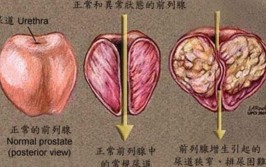 天冷排尿滴答漏 爹爹时常湿裤子 前列腺不好老中医教您一招(爹爹前列腺排尿顺和尿频)