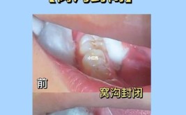 窝沟封闭怎么做？有副作用吗？胶东半岛口腔医院最全解答来了(封闭牙齿口腔医院封闭剂磨牙)