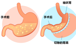一年10000例！“切胃减肥”被滥用还是切得不够？(手术代谢患者医院外科)