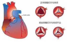 「心脏病讲解」瓣膜病“修复”和“置换”分别是怎么回事？(瓣膜心脏置换病变修复)