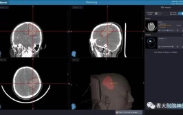 高血压性脑出血患者福音！南华附一医院神经导航精准手术水平再上新高(神经手术导航脑出血患者)