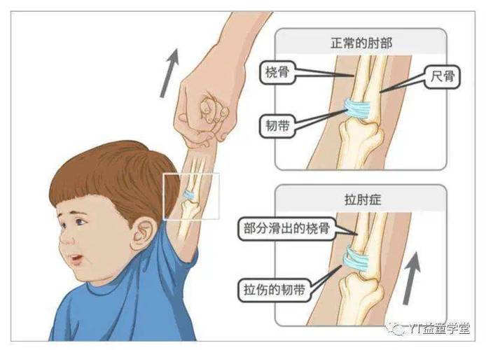 但摔伤骨折你知道怎么办嘛？(骨折桡骨尺骨孩子脱位) 汽修知识