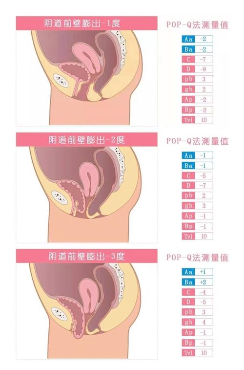 盆腔器官脱垂，如何做修复(尾骨盆腔器官曲度腰部) 汽修知识