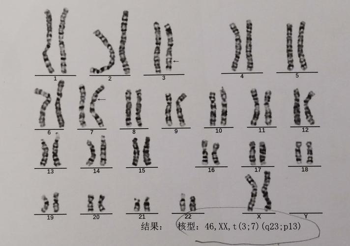 染色体平衡易位寿命短吗 学类资讯