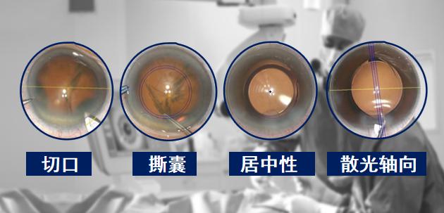 医生运用导航技术成功取出(眼眶手术玻璃医生导航) 汽修知识